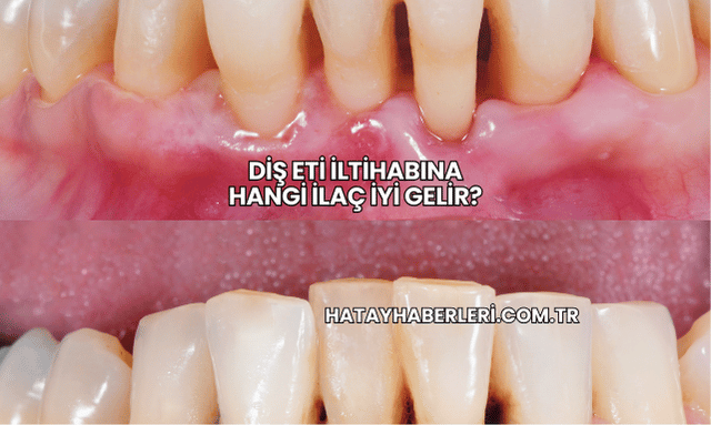 Diş Eti İltihabına Hangi İlaç İyi Gelir?