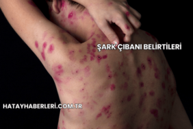 Şark Çıbanı Belirtileri