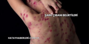 Şark Çıbanı Belirtileri