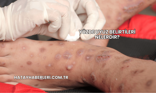 Yüzde Uyuz Belirtileri Nelerdir?