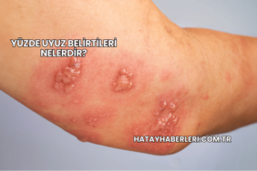 Yüzde Uyuz Belirtileri Nelerdir?